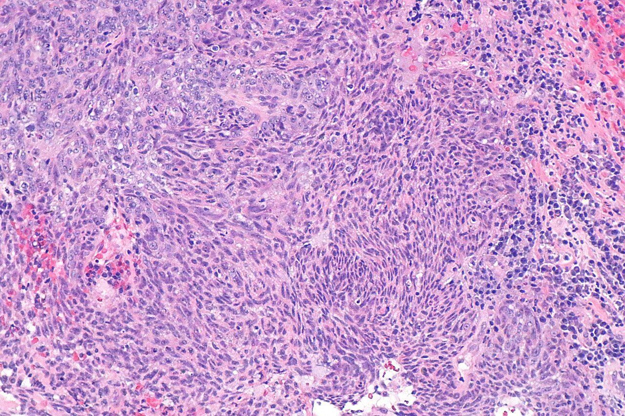 鼻咽癌组织染色显微图像